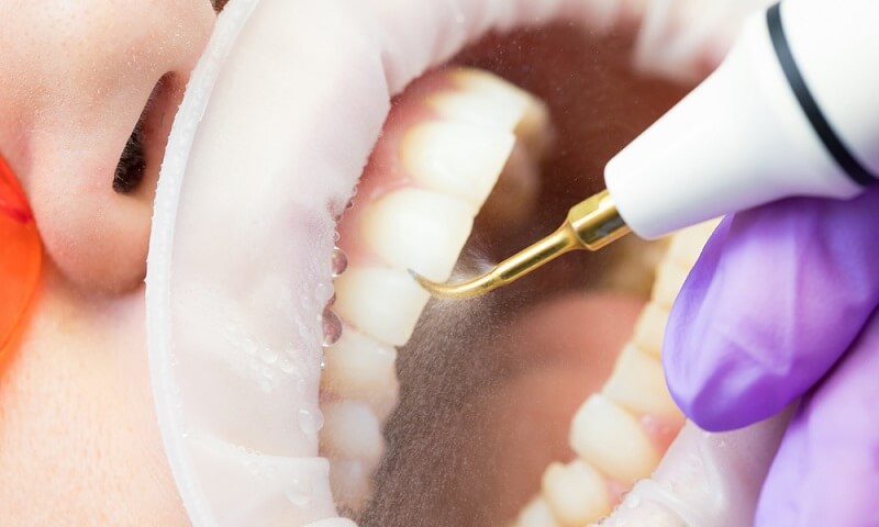 Perawatan gigi dengan asuransi kesehatan