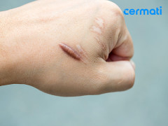 Kenali Keloid, Jaringan Parut yang Mengganggu Penampilanmu