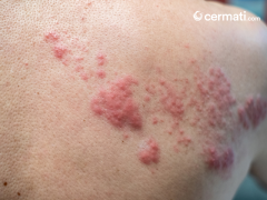 Sukar Sembuh? Inilah Jenis, Tahapan, dan Gejala Herpes yang Perlu Diketahui