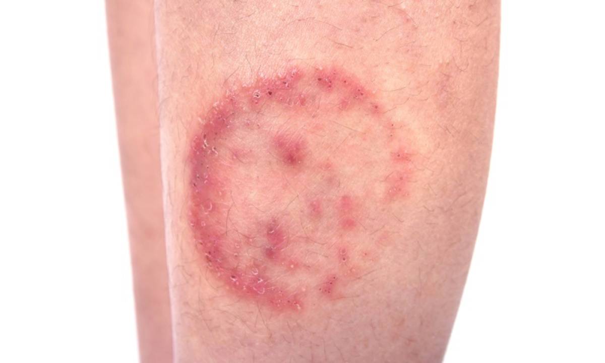 Obat alami bintik merah pada kulit disertai gatal