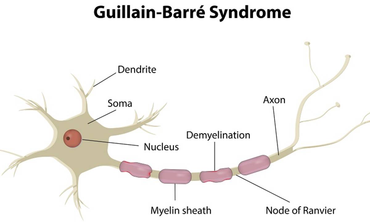 Autoimun guillain barre syndrome adalah