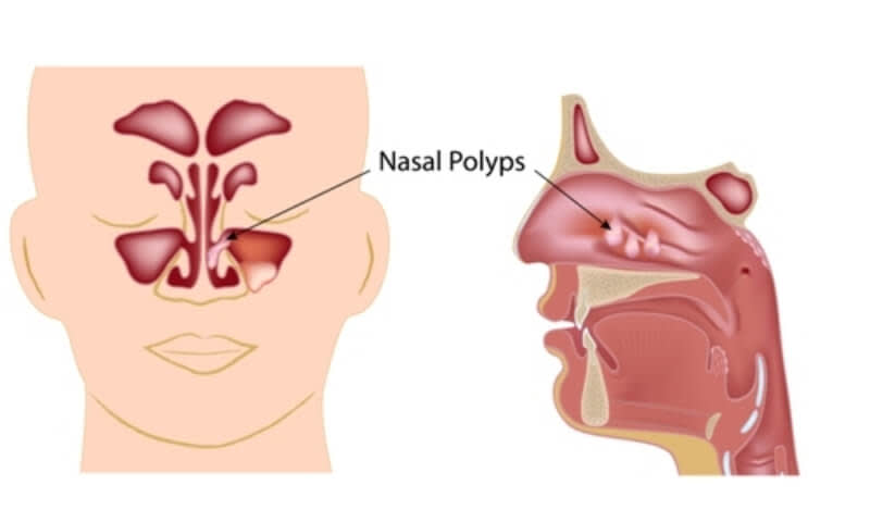 Apa Itu Polip Hidung