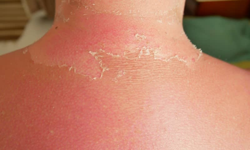 sun burn