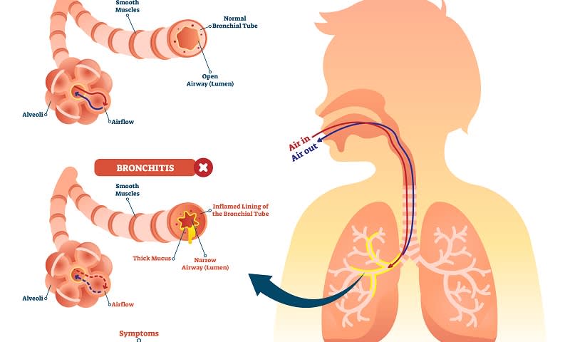 Bronkhitis