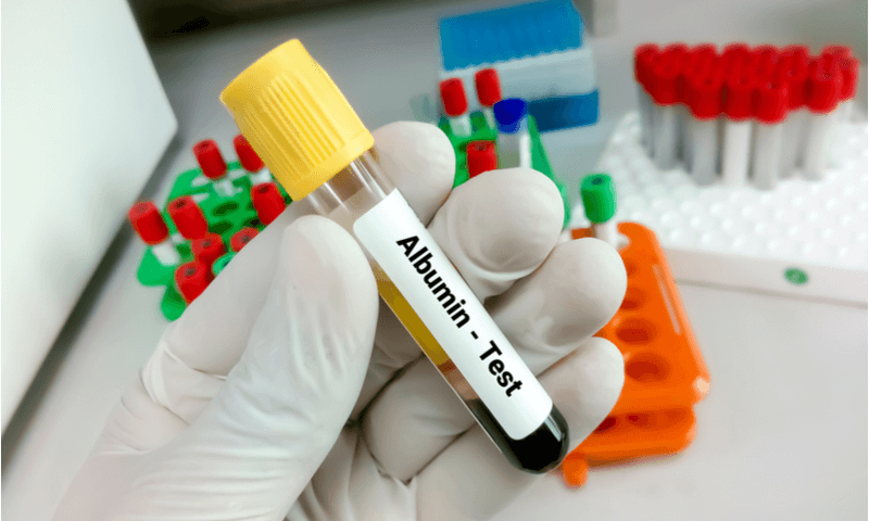 Pengertian Albuminuria