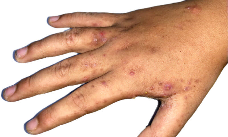 Cara Mengobati Scabies