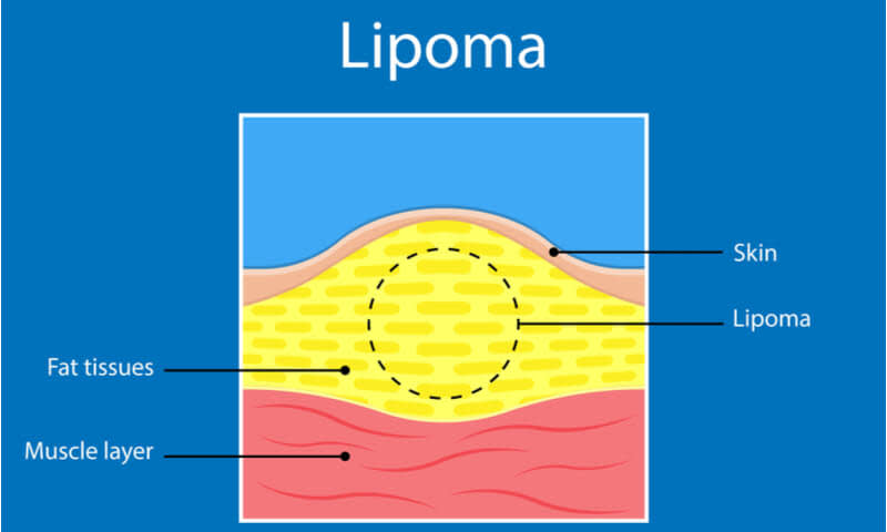 Diagnosis Lipoma