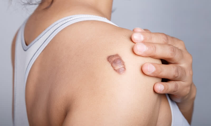keloid